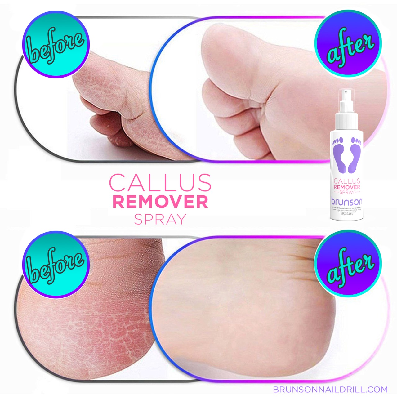 Callus Remover Spray